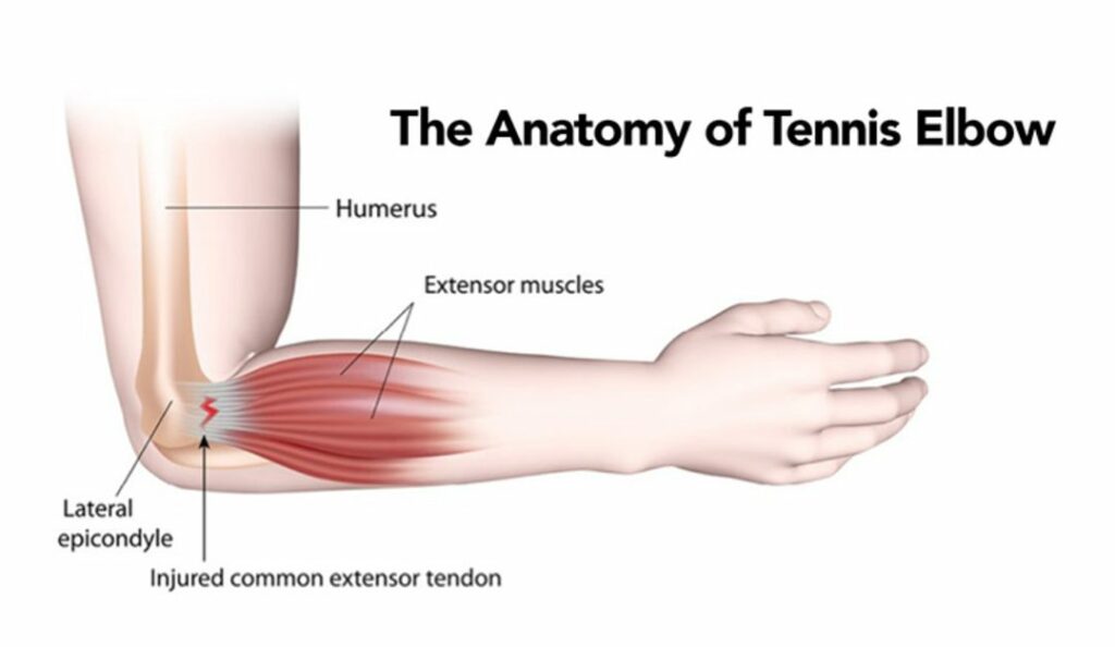 Anatomy of Tennis Elbow 1080x627 1