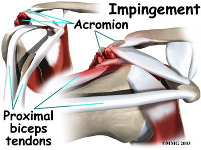 Impingement