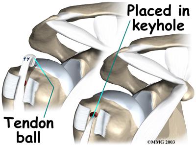 PlacedKeyhole