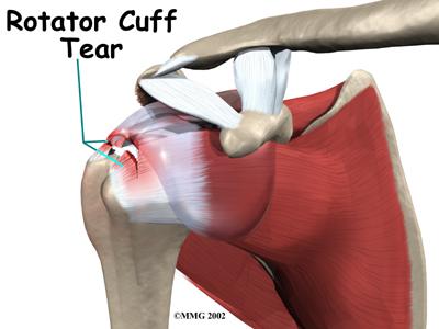 RotatorCuffTear