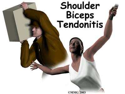 biceptendonitis1